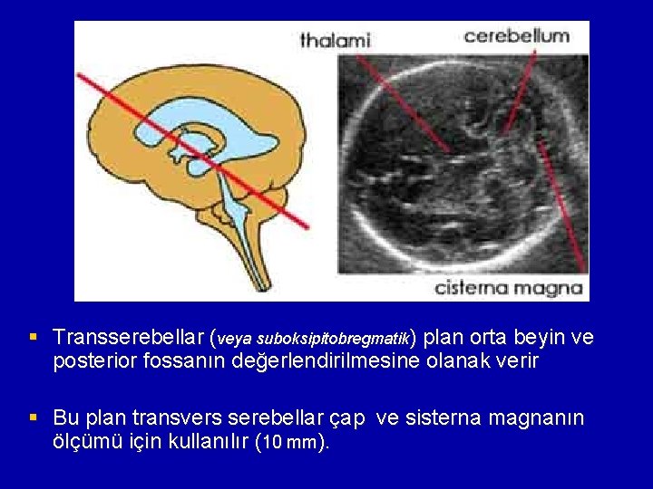 § Transserebellar (veya suboksipitobregmatik) plan orta beyin ve posterior fossanın değerlendirilmesine olanak verir §
