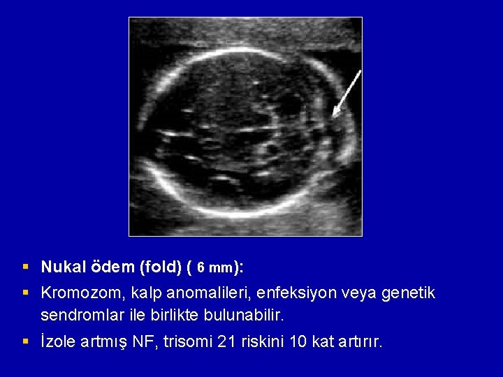 § Nukal ödem (fold) ( 6 mm): § Kromozom, kalp anomalileri, enfeksiyon veya genetik