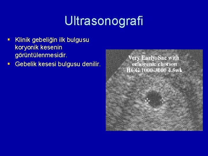 Ultrasonografi § Klinik gebeliğin ilk bulgusu koryonik kesenin görüntülenmesidir. § Gebelik kesesi bulgusu denilir.