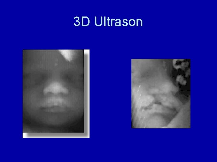 3 D Ultrason 
