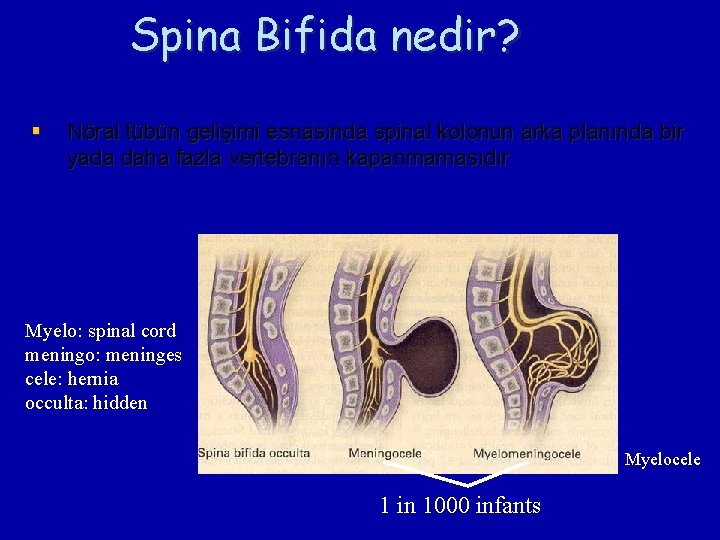 Spina Bifida nedir? § Nöral tübün gelişimi esnasında spinal kolonun arka planında bir yada