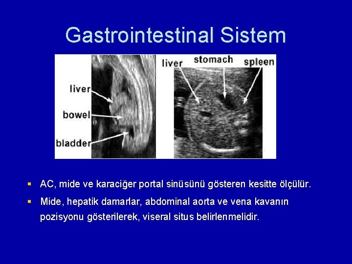 Gastrointestinal Sistem § AC, mide ve karaciğer portal sinüsünü gösteren kesitte ölçülür. § Mide,