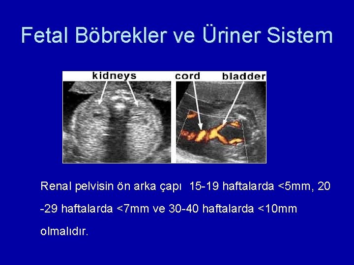 Fetal Böbrekler ve Üriner Sistem Renal pelvisin ön arka çapı 15 -19 haftalarda <5