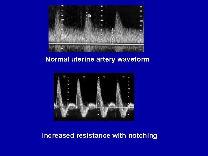 Normal uterine artery waveform Increased resistance with notching 