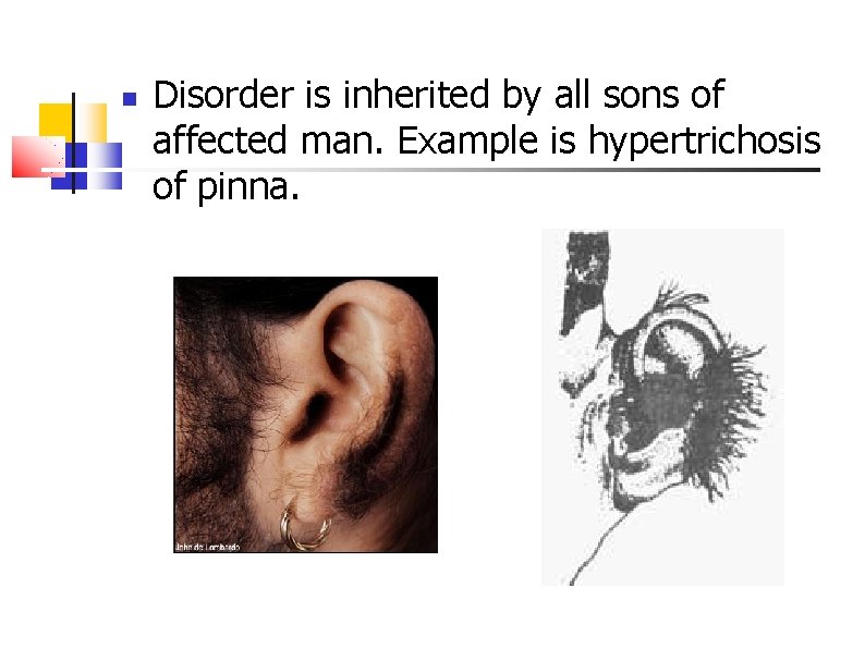  Disorder is inherited by all sons of affected man. Example is hypertrichosis of