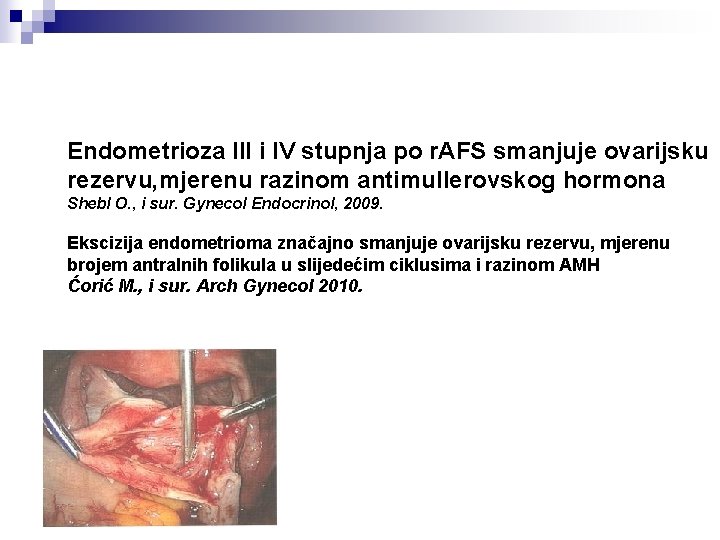 Endometrioza III i IV stupnja po r. AFS smanjuje ovarijsku rezervu, mjerenu razinom antimullerovskog