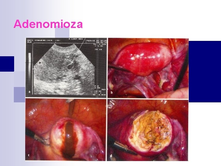 Adenomioza 