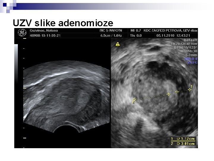 UZV slike adenomioze 