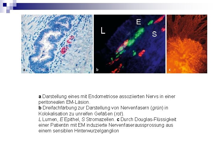 a Darstellung eines mit Endometriose assoziierten Nervs in einer peritonealen EM-Läsion. b Dreifachfärbung zur