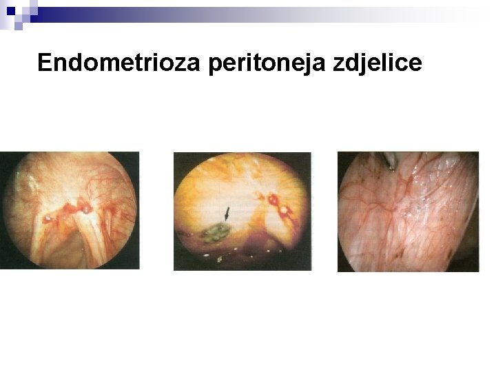 Endometrioza peritoneja zdjelice 