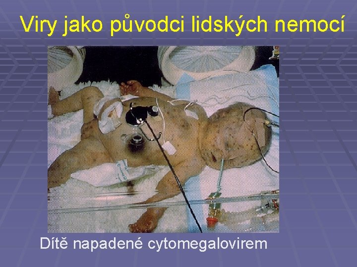 Viry jako původci lidských nemocí Dítě napadené cytomegalovirem 