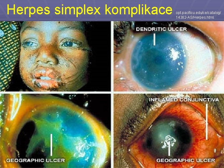 Herpes simplex komplikace opt. pacificu. edu/ce/catalog/ 14382 -AS/Herpes. html. 