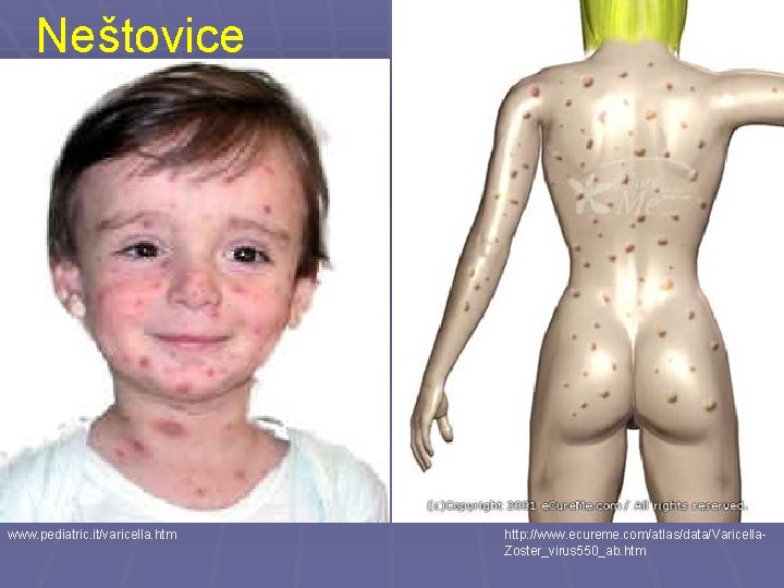 Neštovice www. pediatric. it/varicella. htm http: //www. ecureme. com/atlas/data/Varicella. Zoster_virus 550_ab. htm 