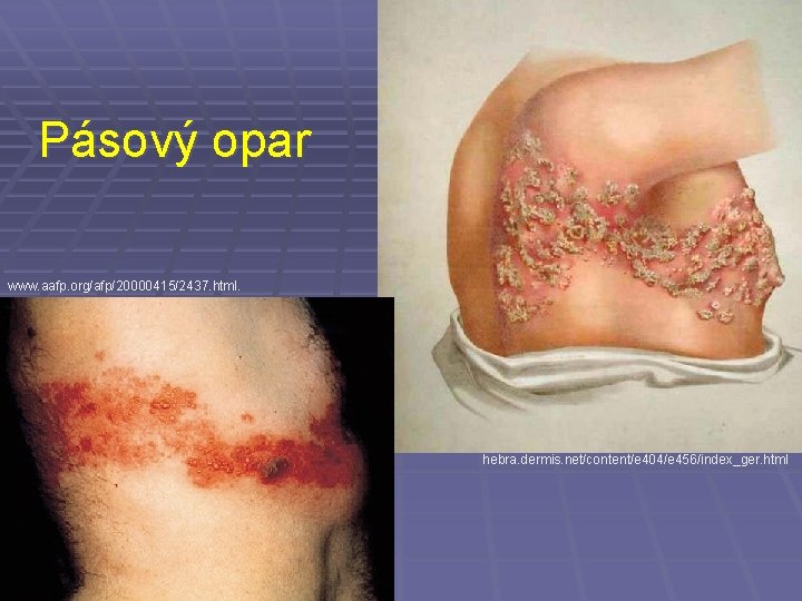 Pásový opar www. aafp. org/afp/20000415/2437. html. hebra. dermis. net/content/e 404/e 456/index_ger. html 