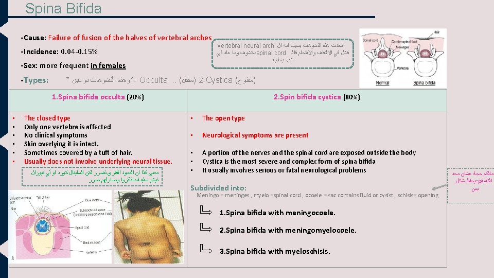 Spina Bifida -Cause: Failure of fusion of the halves of vertebral arches -Incidence: 0.