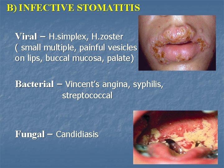 B) INFECTIVE STOMATITIS Viral – H. simplex, H. zoster ( small multiple, painful vesicles