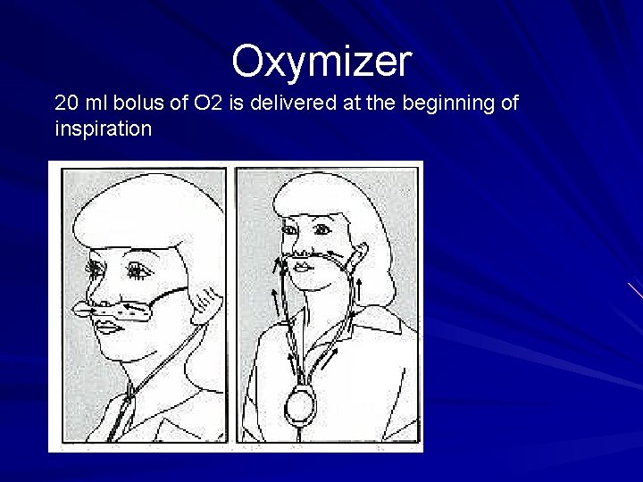 Oxymizer 20 ml bolus of O 2 is delivered at the beginning of inspiration