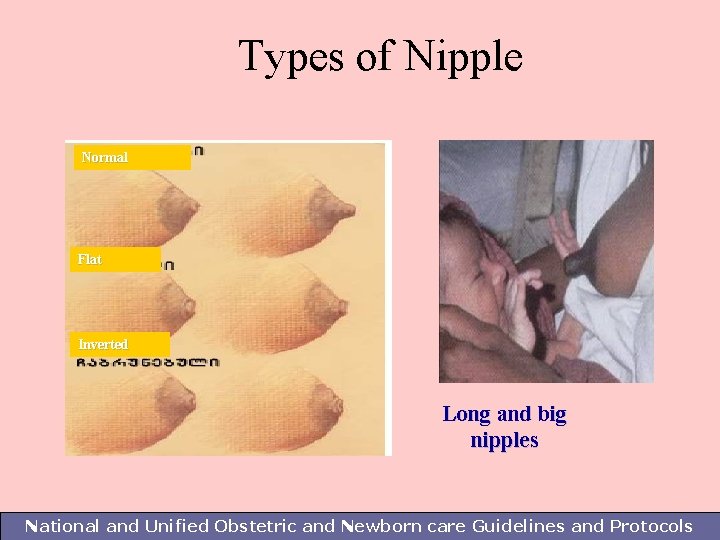 Types of Nipple Normal Flat Inverted Long and big nipples National and Unified Obstetric