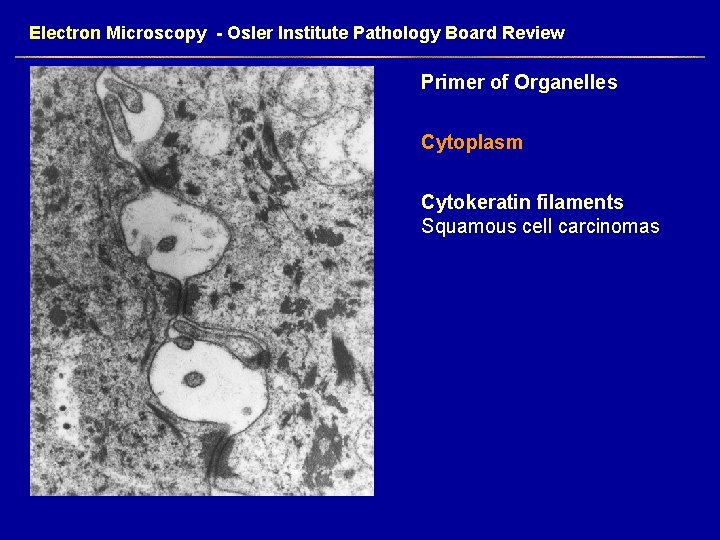 Electron Microscopy - Osler Institute Pathology Board Review Primer of Organelles Cytoplasm Cytokeratin filaments