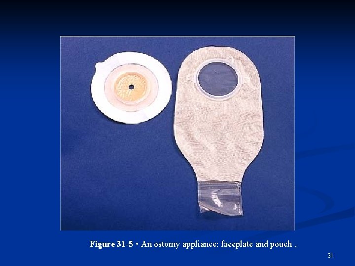 Figure 31 -5 • An ostomy appliance: faceplate and pouch. 31 