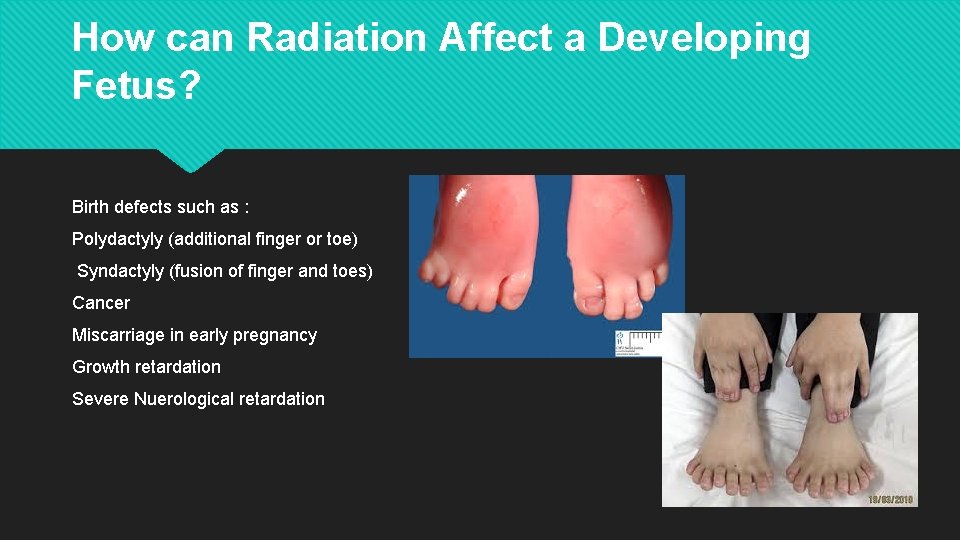 How can Radiation Affect a Developing Fetus? Birth defects such as : Polydactyly (additional