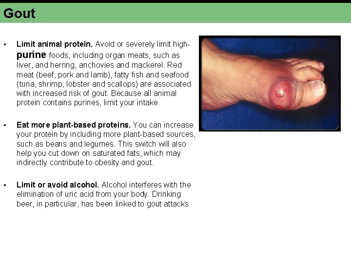 Gout • Limit animal protein. Avoid or severely limit highpurine foods, including organ meats,