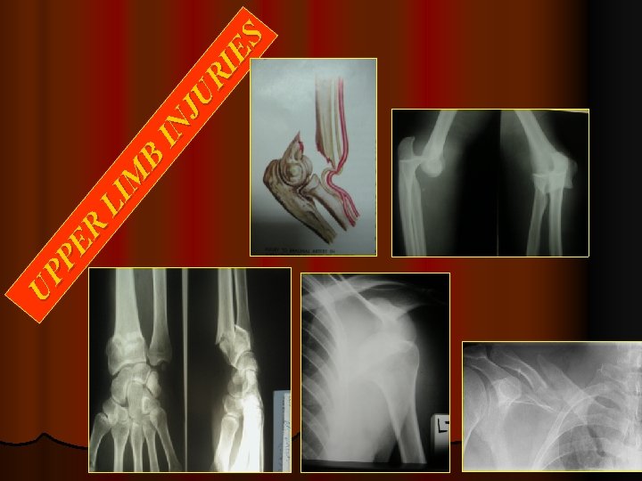 UP PE R LI M B IN JU RI ES 