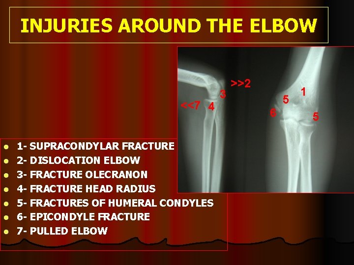 INJURIES AROUND THE ELBOW <<7 4 l l l l 1 - SUPRACONDYLAR FRACTURE