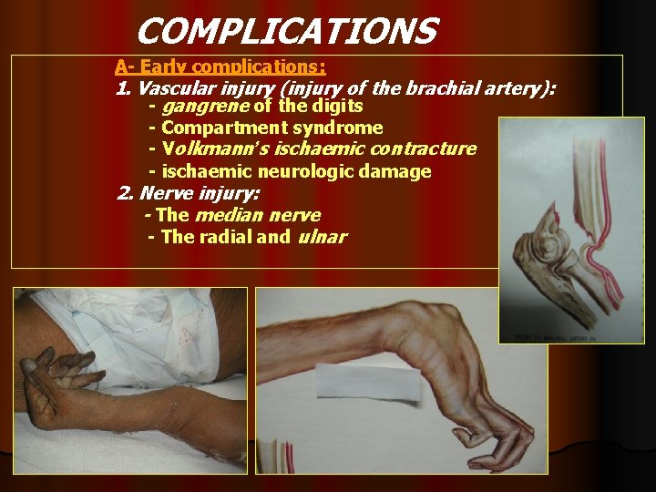 COMPLICATIONS A- Early complications: 1. Vascular injury (injury of the brachial artery): - gangrene