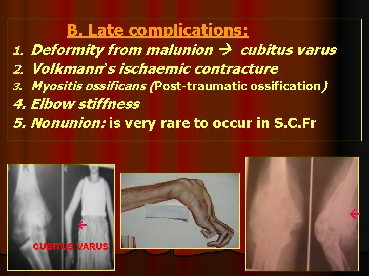 B. Late complications: 1. 2. Deformity from malunion cubitus varus Volkmann’s ischaemic contracture 3.