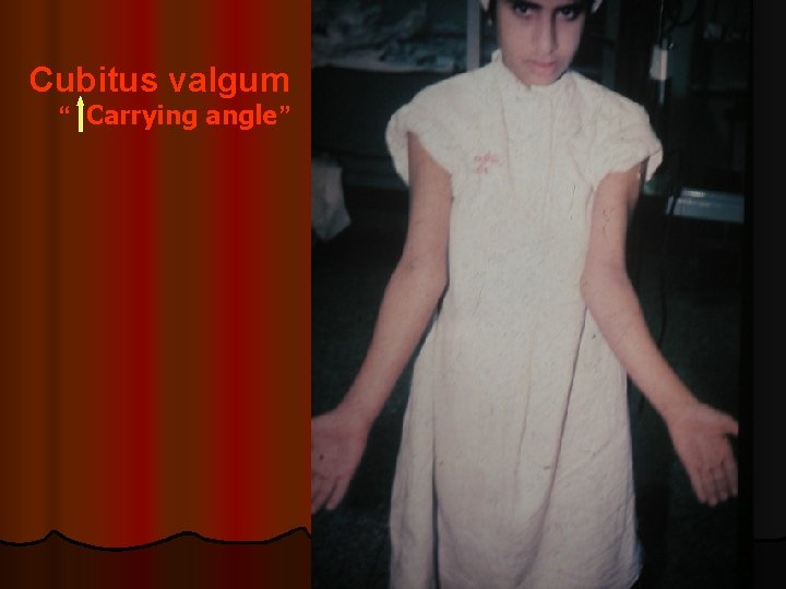 Cubitus valgum “ Carrying angle” 