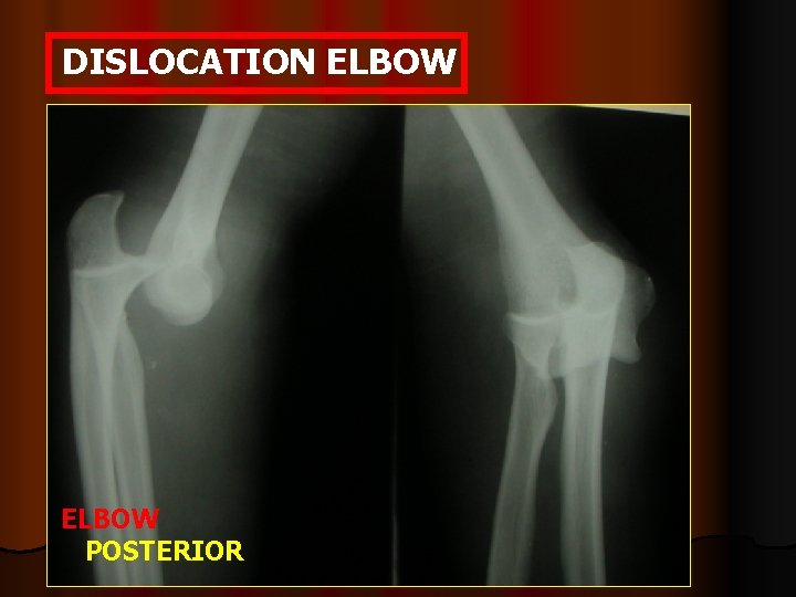 DISLOCATION ELBOW POSTERIOR 