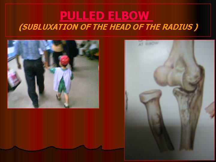 PULLED ELBOW (SUBLUXATION OF THE HEAD OF THE RADIUS ) 