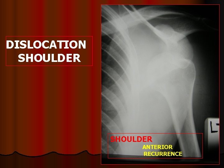 DISLOCATION SHOULDER ANTERIOR RECURRENCE 