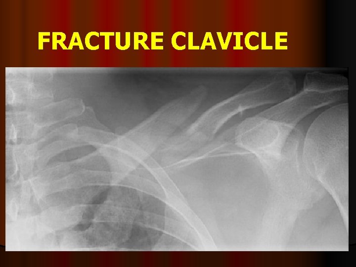 FRACTURE CLAVICLE 