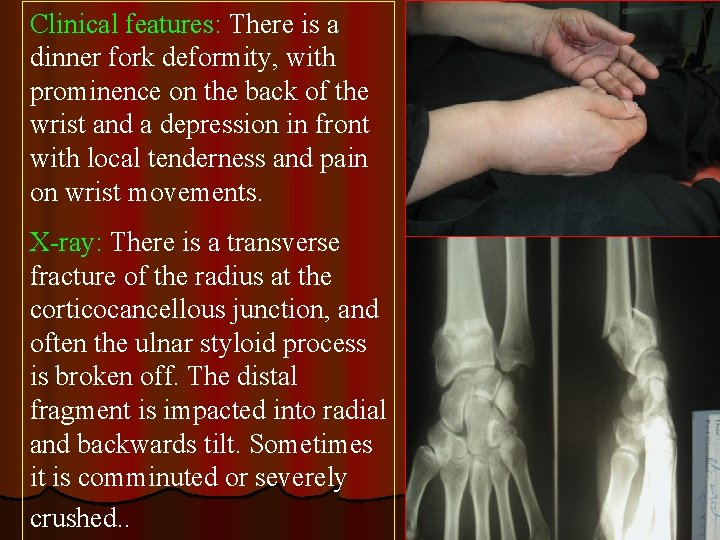 UPPER LIMB FRACTURES FRACTURES CLINICAL PICTURE INVESTIGATIONS TREATMENT