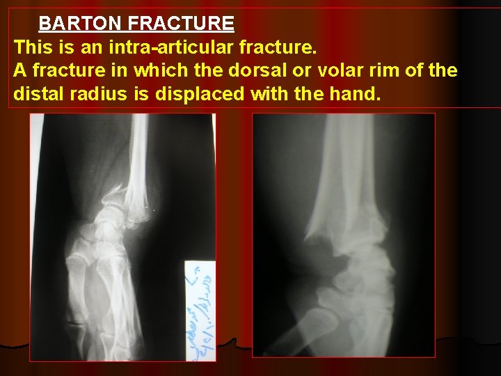 BARTON FRACTURE This is an intra-articular fracture. A fracture in which the dorsal or