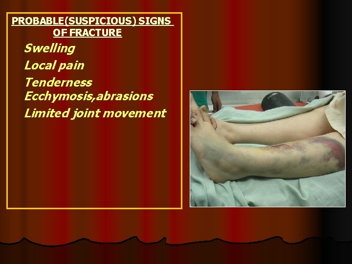PROBABLE(SUSPICIOUS) SIGNS OF FRACTURE Swelling Local pain Tenderness Ecchymosis, abrasions Limited joint movement 