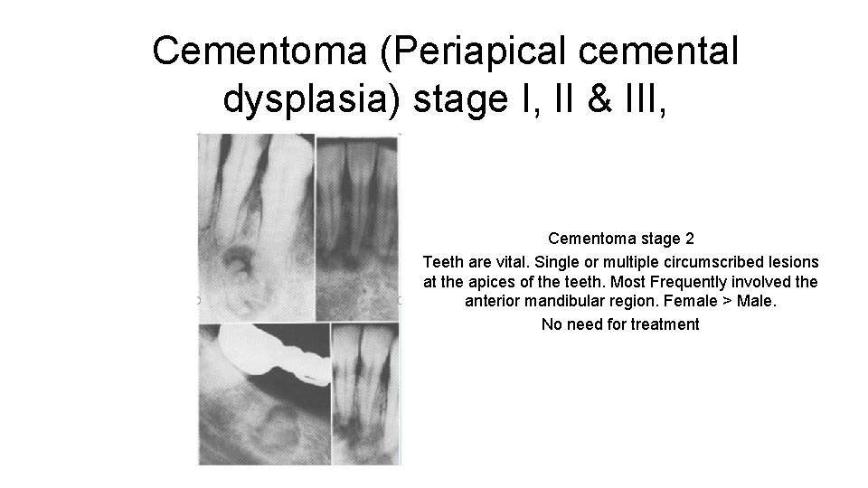 Cementoma (Periapical cemental dysplasia) stage I, II & III, Cementoma stage 2 Teeth are