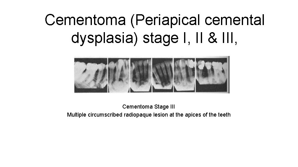 Cementoma (Periapical cemental dysplasia) stage I, II & III, Cementoma Stage III Multiple circumscribed