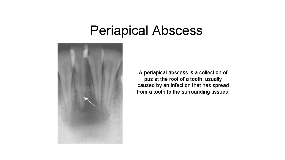 Periapical Abscess A periapical abscess is a collection of pus at the root of