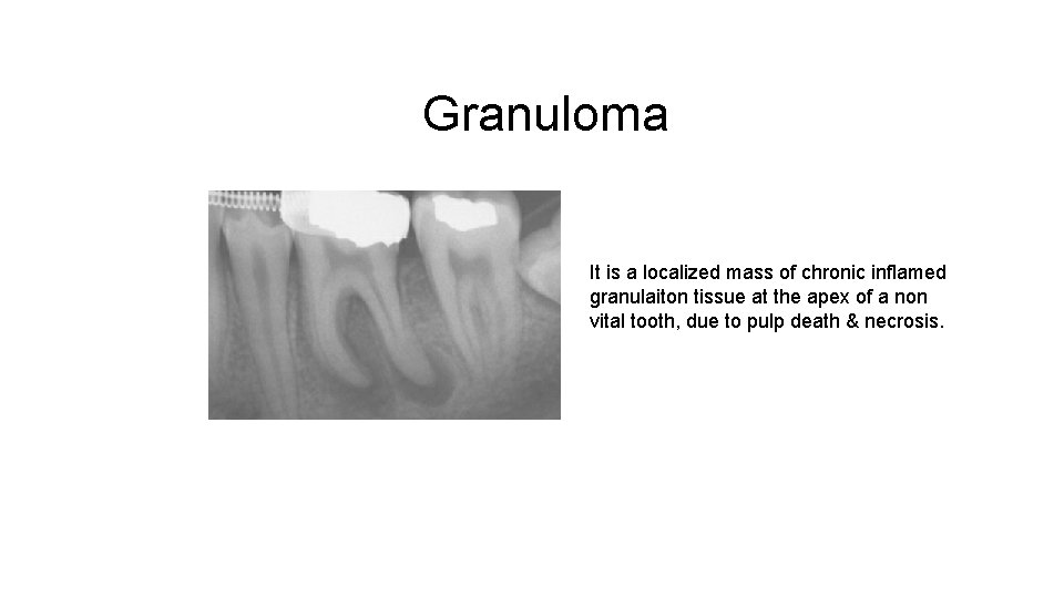 Granuloma It is a localized mass of chronic inflamed granulaiton tissue at the apex