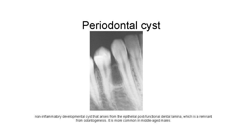 Periodontal cyst non-inflammatory developmental cyst that arises from the epithelial post-functional dental lamina, which
