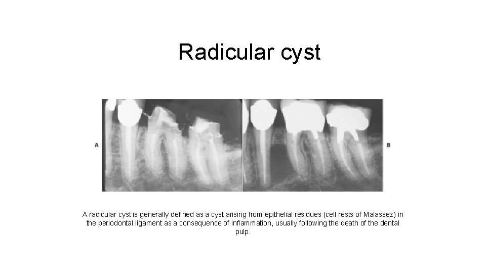 Radicular cyst A radicular cyst is generally defined as a cyst arising from epithelial