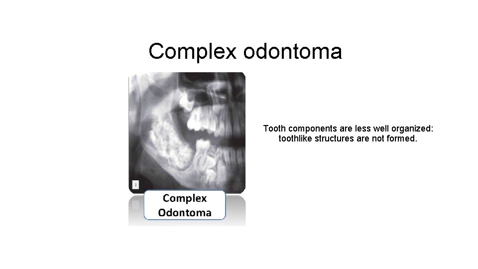 Complex odontoma Tooth components are less well organized: toothlike structures are not formed. 