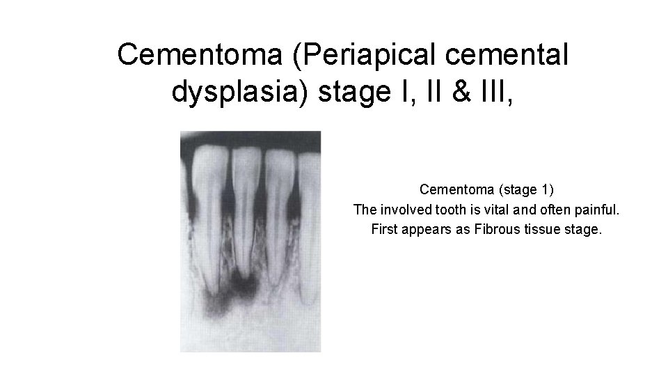 Cementoma (Periapical cemental dysplasia) stage I, II & III, Cementoma (stage 1) The involved