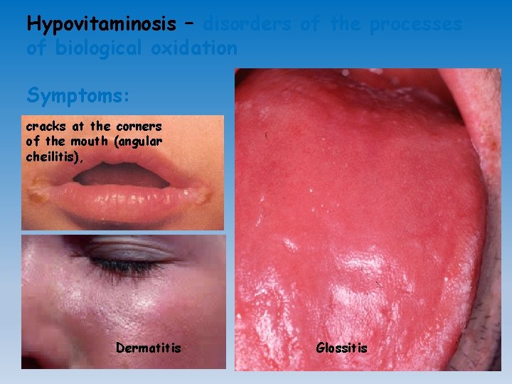 Hypovitaminosis – disorders of the processes of biological oxidation Symptoms: cracks at the corners