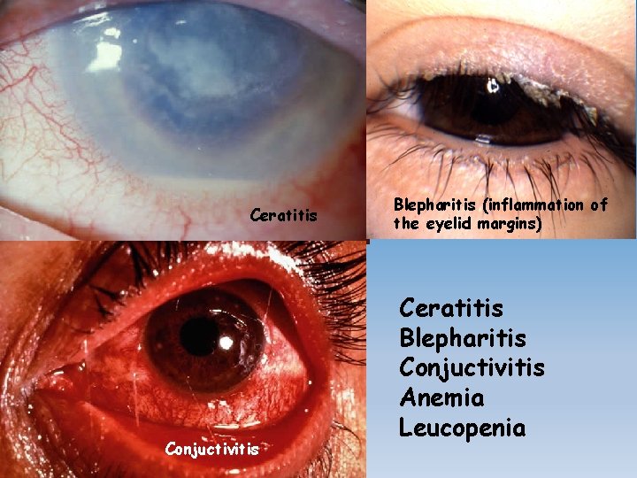 Ceratitis Conjuctivitis Blepharitis (inflammation of the eyelid margins) Ceratitis Blepharitis Conjuctivitis Anemia Leucopenia 