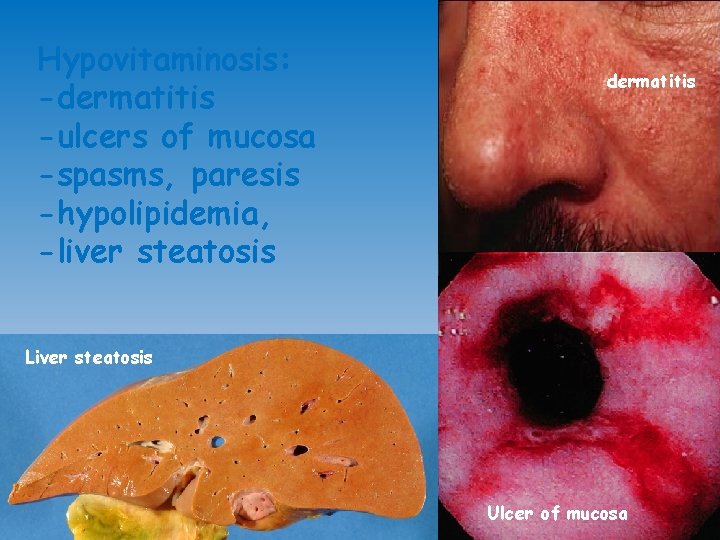 Hypovitaminosis: -dermatitis -ulcers of mucosa -spasms, paresis -hypolipidemia, -liver steatosis dermatitis Liver steatosis Ulcer