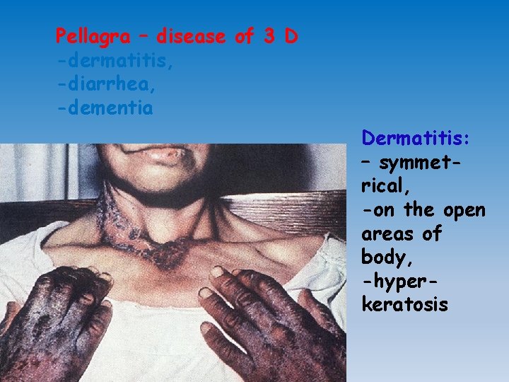 Pellagra – disease of 3 D -dermatitis, -diarrhea, -dementia Dermatitis: – symmetrical, -on the